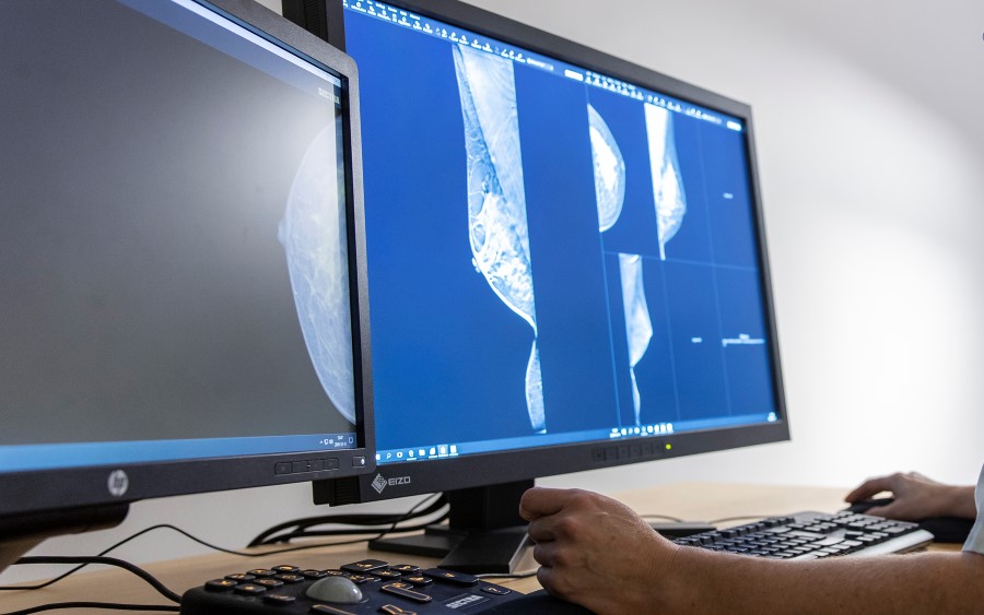 Screening del cancro al seno assistito dall’intelligenza artificiale: risultati promettenti ma rimangono molte domande